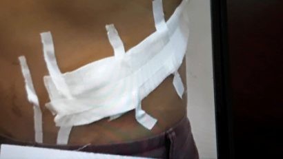  Một nạn nhân sau khi bán đi một quả thận.